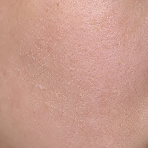 Close-up of dry skin