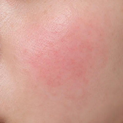 Close-up of sensitive skin